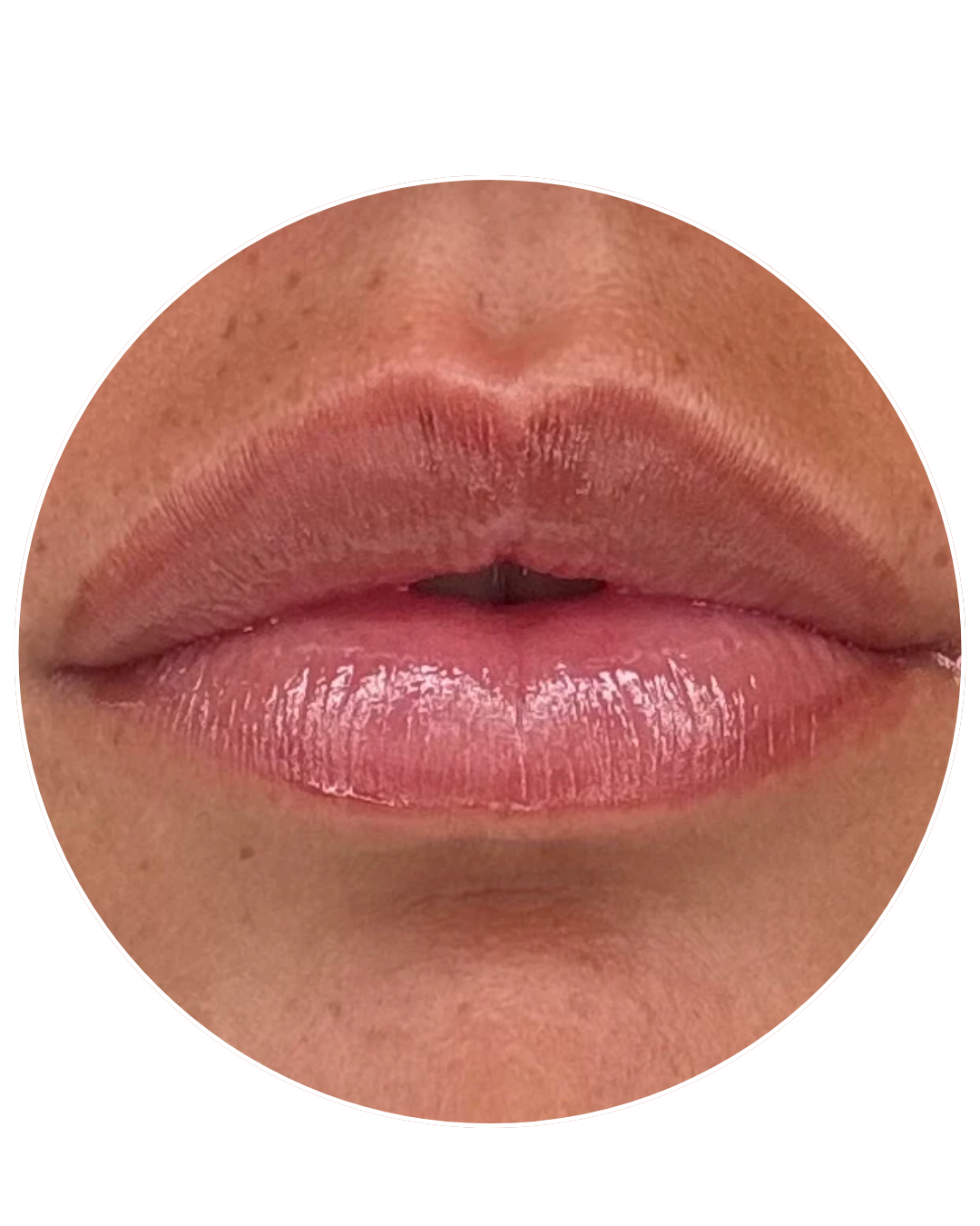 Resultado final de labios voluminosos